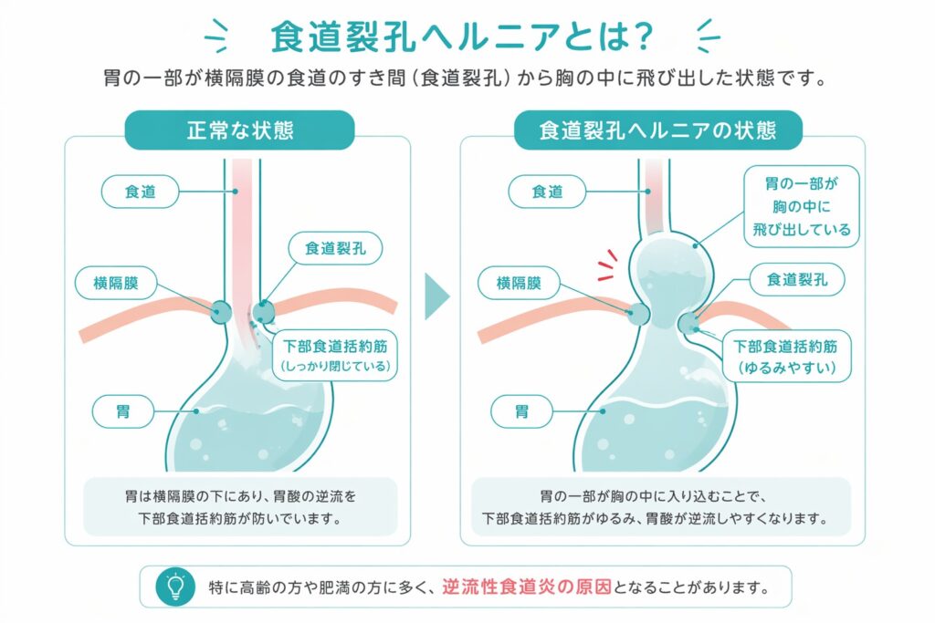 東京都豊島区大塚のおなかとおしりのクリニック 東京大塚の食道裂孔ヘルニアのイラスト