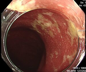 東京都豊島区大塚のおなかとおしりのクリニック 東京大塚 潰瘍性大腸炎の内視鏡画像
