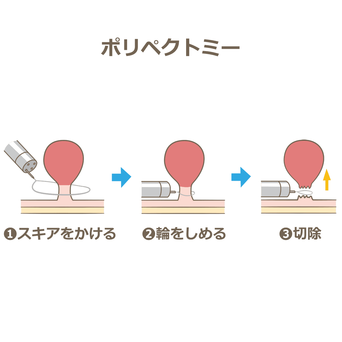 内視鏡的ポリープ切除（ポリペク）のイメージ図