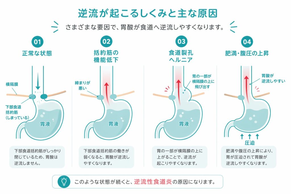 東京都島区大塚のおなかとおしりのクリニック 東京大塚の胸焼けの原因のイラスト