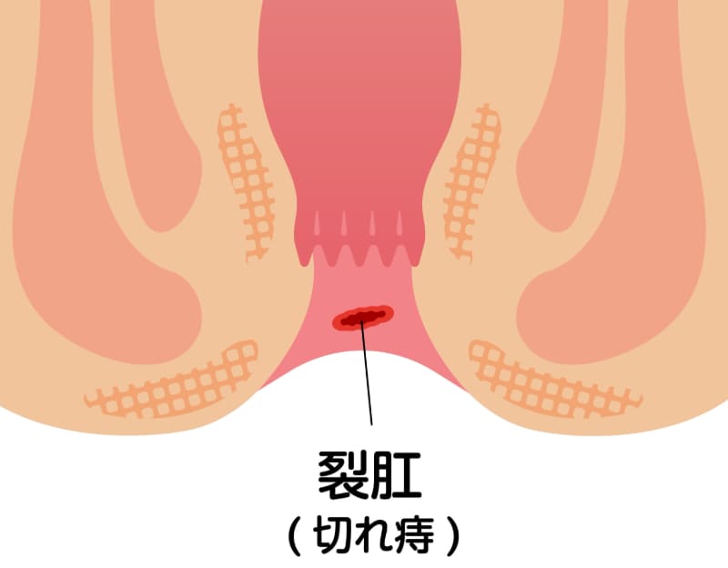 裂肛