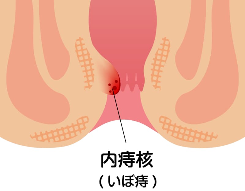 内痔核