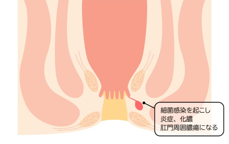 肛門周囲膿瘍