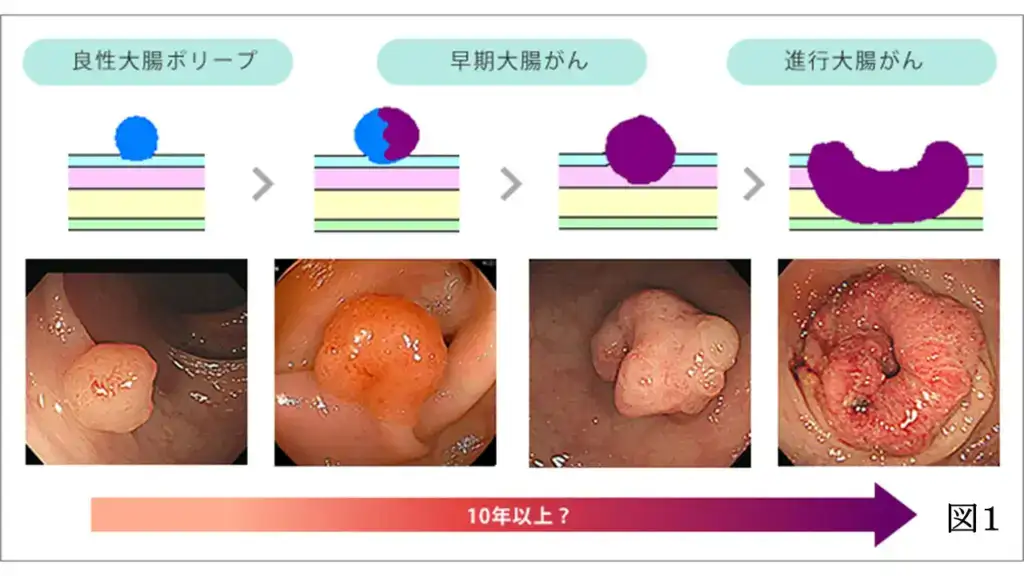 東京都豊島区大塚のおなかとおしりのクリニック 東京大塚の大腸ポリープから大腸がんに進行する画像。