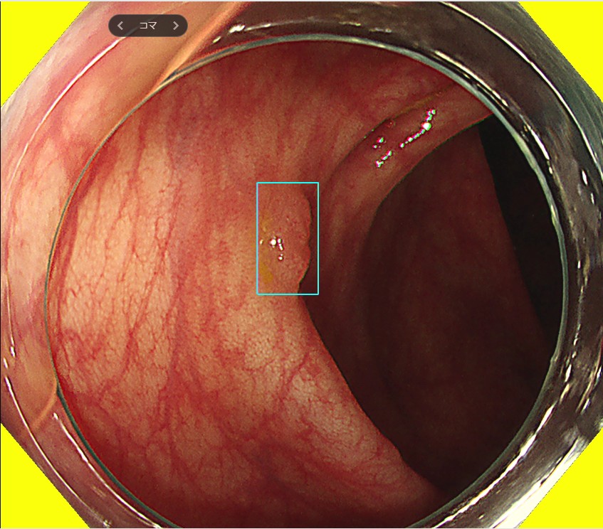 AIが大腸ポリープを描出する大腸カメラ写真｜豊島区肛門科で便潜血陽性時に精査