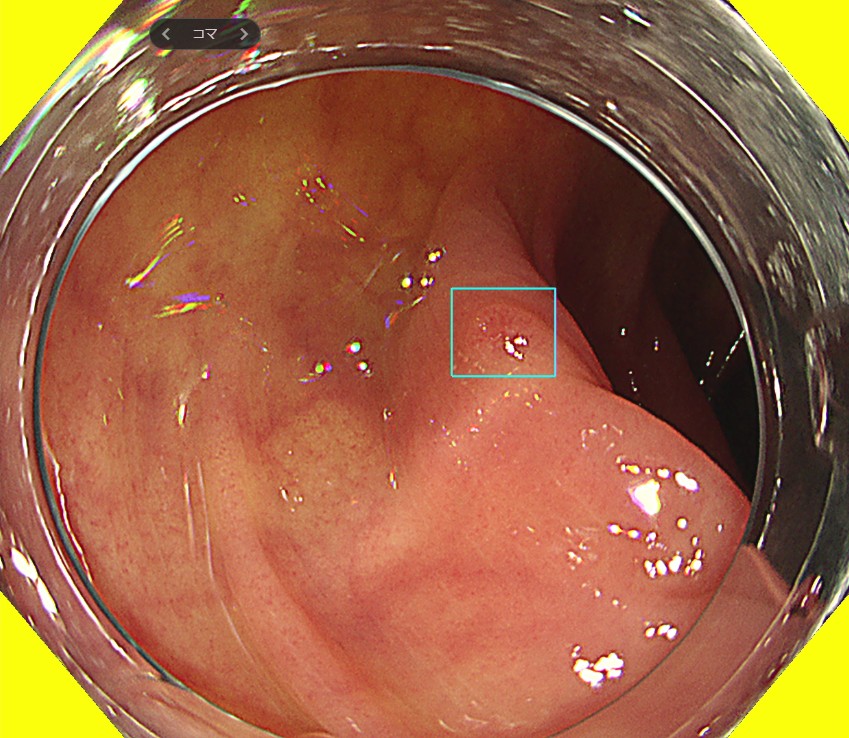 AIが病変を検出している写真|豊島区肛門科で便潜血や下痢など過敏性腸症候群の影に潜む病気を大腸カメラで精査