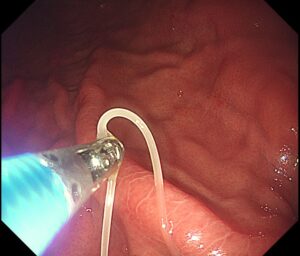 豊島区　胃がん検診対応胃カメラ検査によるアニサキス摘出写真