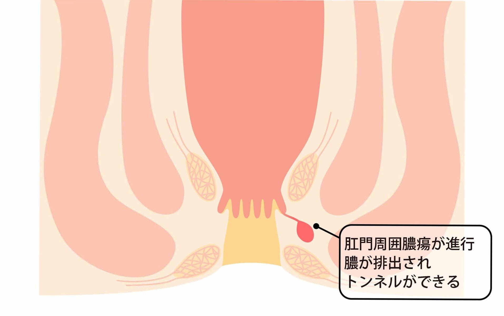 肛門周囲膿瘍ができるしくみ。肛門のくぼみから細菌が入り、肛門腺で感染が起こって膿がたまる過程を示した模式図
