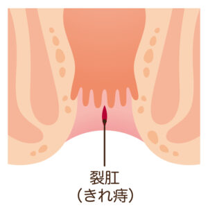 豊島区(池袋エリアからアクセス良好)おなかとおしりのクリニック 東京大塚の「産後のいぼ痔(内痔核)・切れ痔(裂肛)に悩む女性へ|豊島区・池袋で女性にやさしい肛門科」というコラム内の裂肛(切れ痔)のイラスト