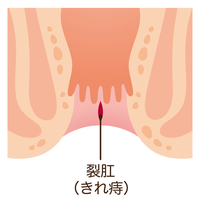 裂肛を解説するイラスト|豊島区肛門科で突然のおしりの痛みの原因や便潜血陽性時の大腸カメラ検査を相談