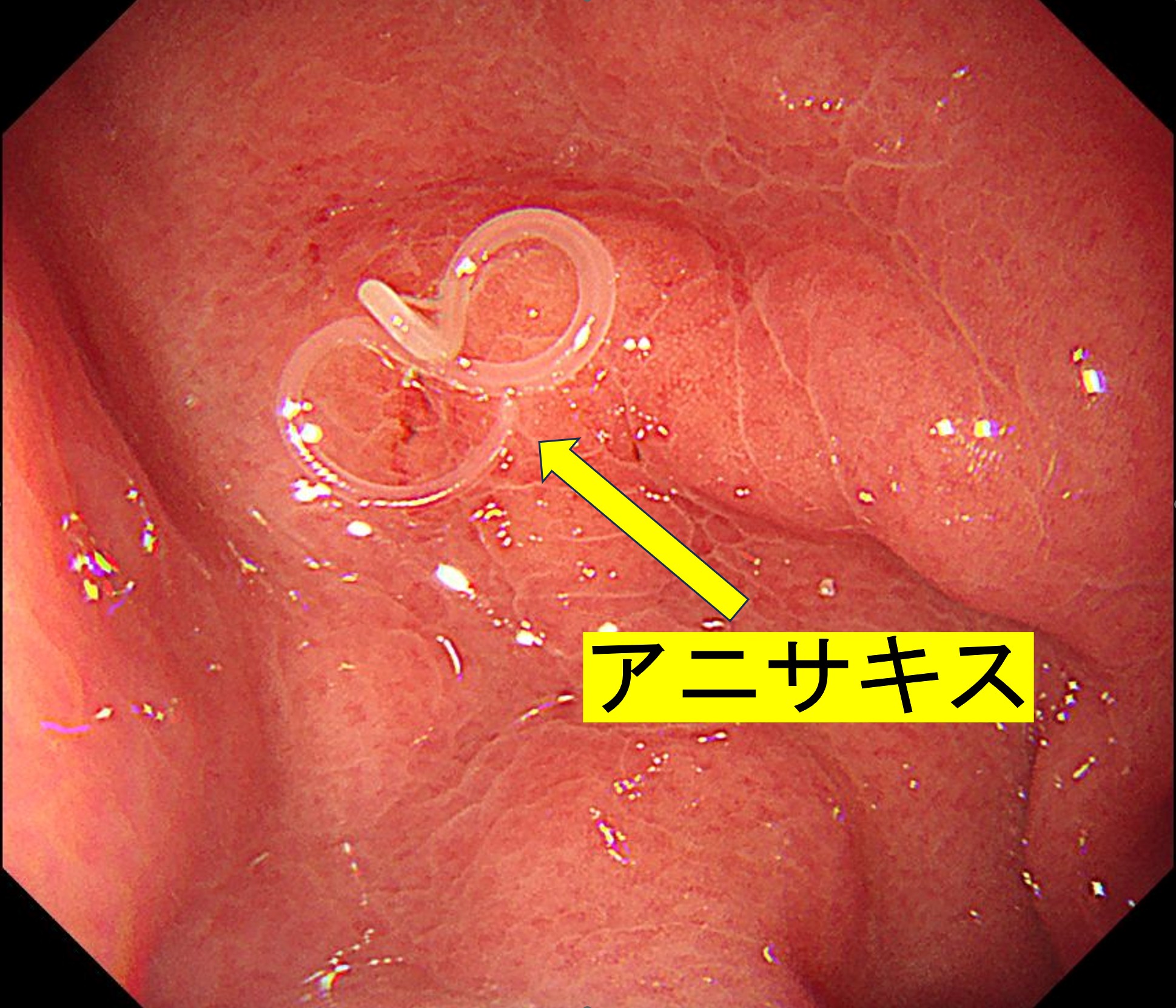 アニサキス症とは？胃の激痛に要注意｜原因・症状・治療を医師が解説