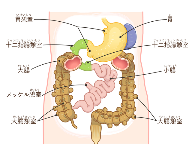 豊島区　便潜血陽性にて無痛大腸カメラ検査施行時に大腸憩室があったイラスト。
消化器内科・肛門科、豊島区胃がん検診対応。
