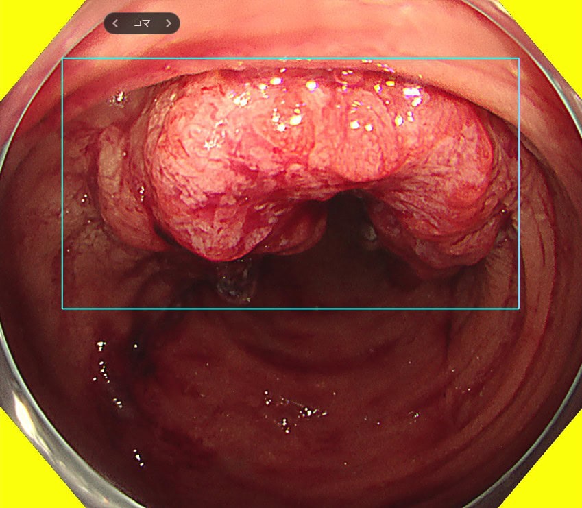東京都豊島区大塚のおなかとおしりのクリニック 東京大塚のＡＩが検出した大腸がんの内視鏡画像。