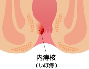 豊島区(池袋エリアからアクセス良好)おなかとおしりのクリニック 東京大塚の「産後のいぼ痔(内痔核)・切れ痔(裂肛)に悩む女性へ|豊島区・池袋で女性にやさしい肛門科」というコラム内のいぼ痔(内痔核)のイラスト