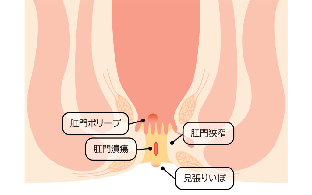豊島区(池袋エリアからアクセス良好)おなかとおしりのクリニック 東京大塚の肛門皮垂(スキンタグ)の説明をする肛門皮垂のイラスト