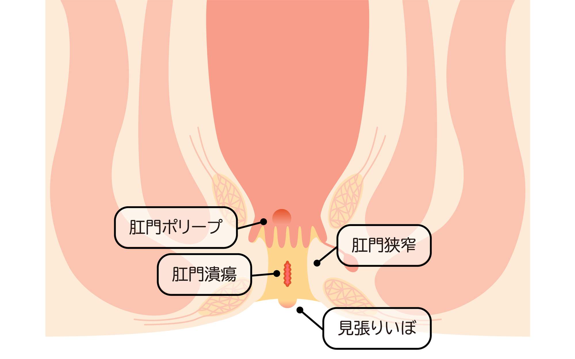 肛門皮垂（スキンタグ）とは？原因・症状・治療を医師が解説｜豊島区・池袋の肛門科