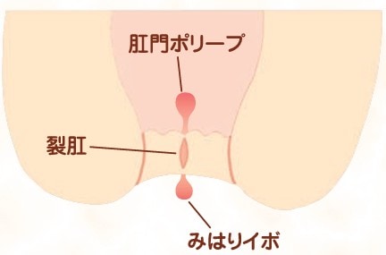豊島区大塚駅徒歩1分のおなかとおしりのクリニック 東京大塚の切れ痔(裂肛）のイラスト