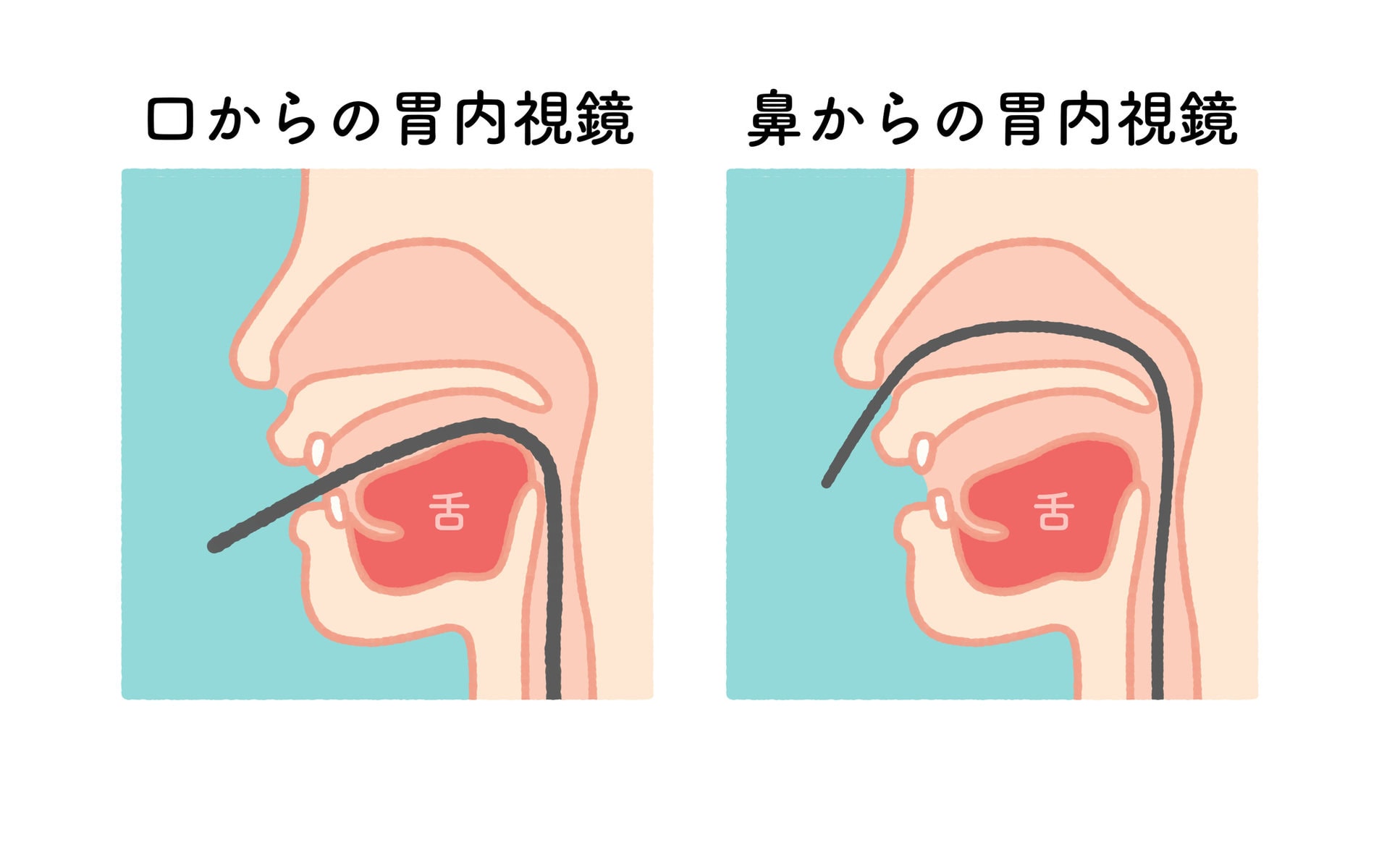 東京都豊島区大塚おなかとおしりのクリニック 東京大塚の経口と経鼻の違いイラスト