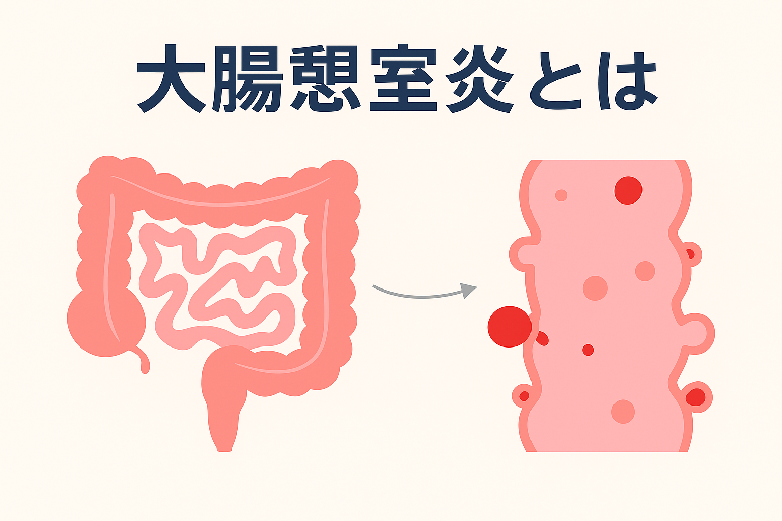 大腸憩室炎とは｜症状・原因・検査・治療を医師がわかりやすく解説
