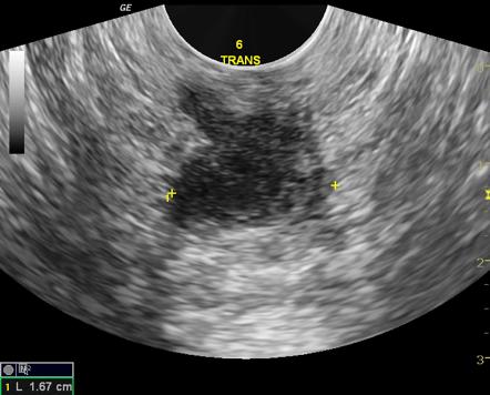 肛門周囲膿瘍の超音波（エコー）検査画像のイメージ