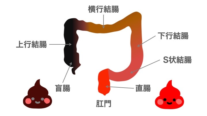 東京都豊島区大塚のおなかとおしりのクリニック 東京大塚の血便出血部位MAPのイラスト