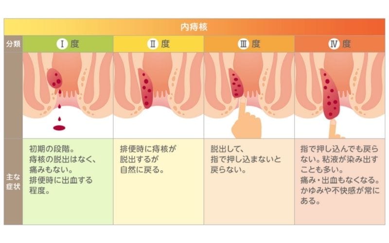 東京都豊島区大塚のおなｋとおしりのクリニック 東京大塚の痔の分類のイラスト