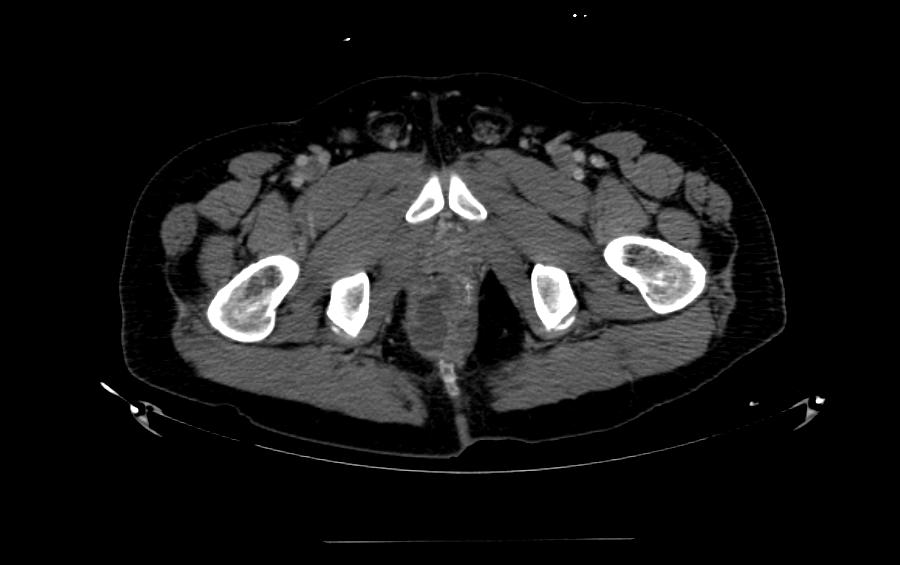 肛門周囲膿瘍のCT検査画像のイメージ