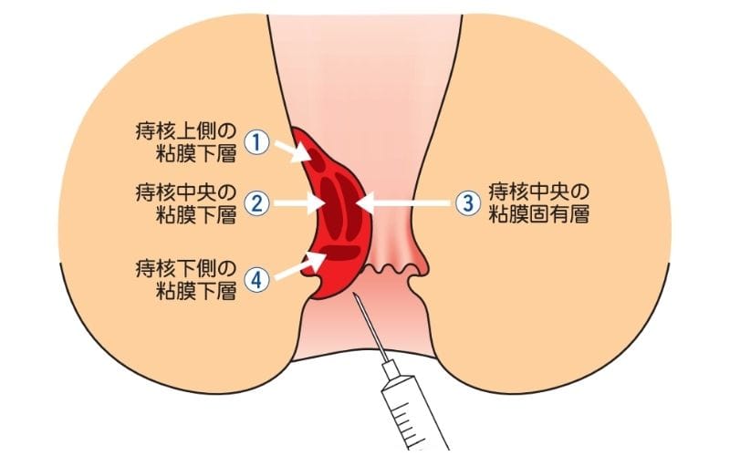 東京都豊島区大塚のおなかとおしりのクリニック 東京大塚のジオン注射のイラスト
