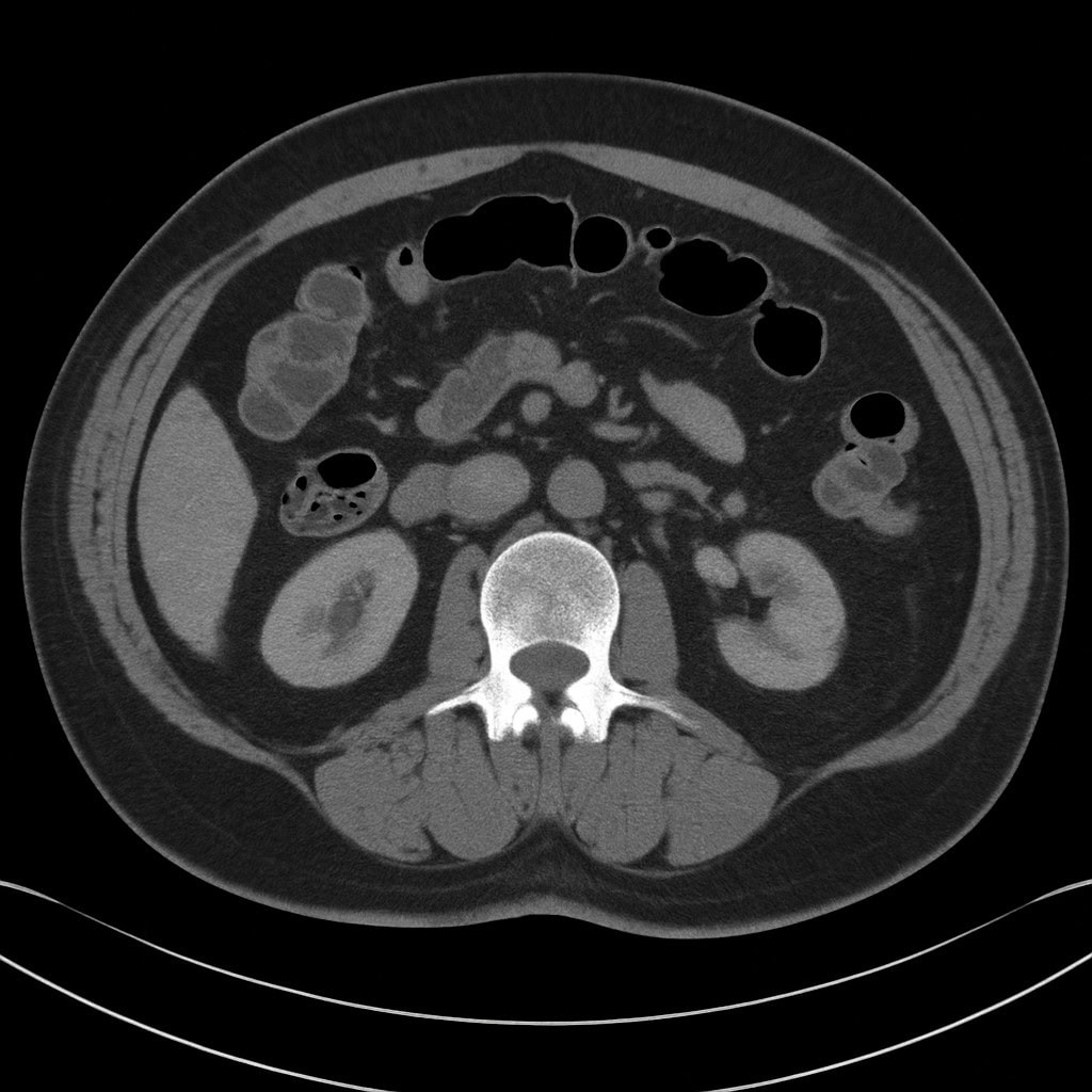 大腸憩室炎 CT検査 診断方法の解説