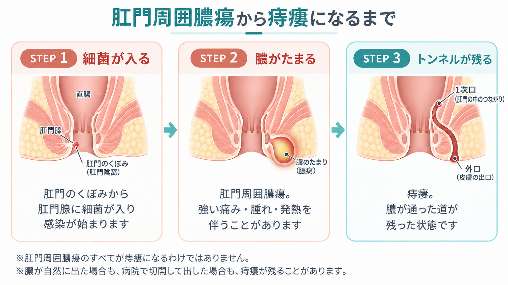 肛門周囲膿瘍から痔瘻になるまでの3ステップを示した図