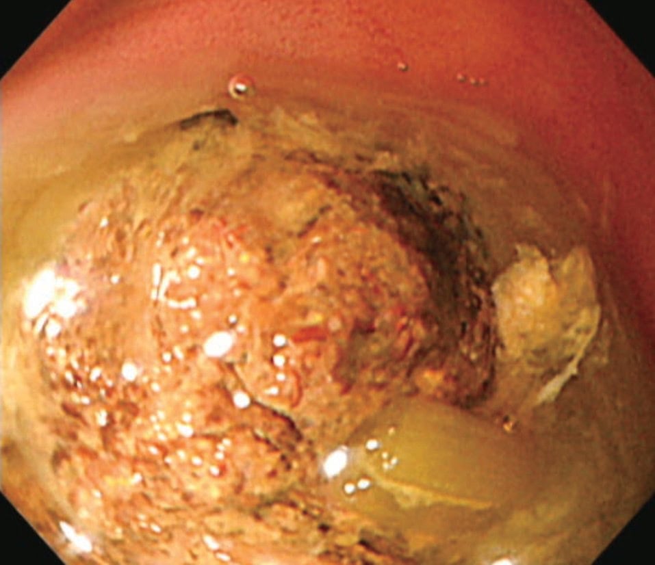 東京都豊島区南大塚のおなかとおしりのクリニック 東京大塚の柿胃石の写真