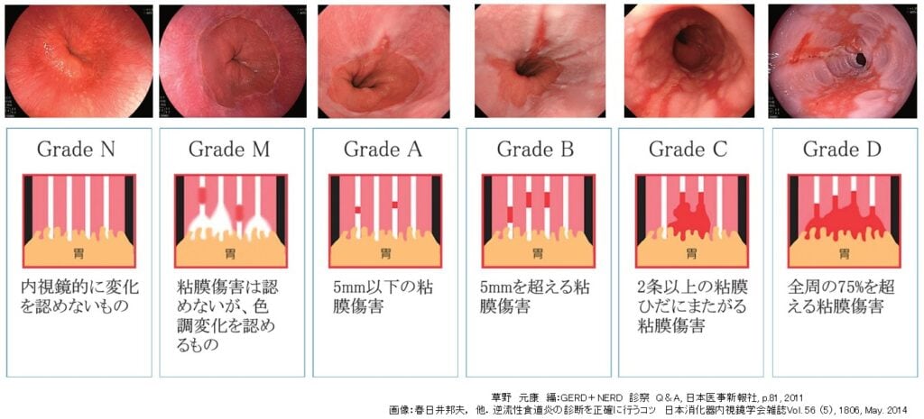 東京都豊島区大塚のおなかとおしりのクリニック 東京大塚のロサンゼルス分類のイラスト