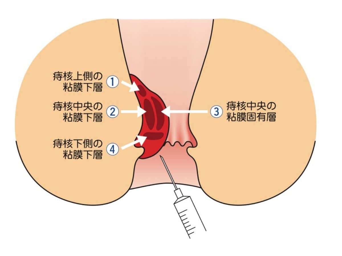 東京都豊島区大塚おなかとおしりのクリニック 東京大塚のジオン注射のイラスト
