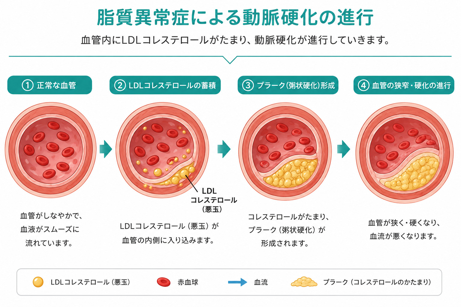 東京都豊島区おなかとおしりのクリニック 東京大塚の動脈硬化のイラスト