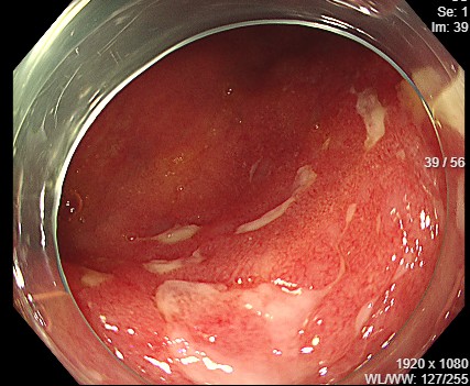 潰瘍性大腸炎内視鏡画像