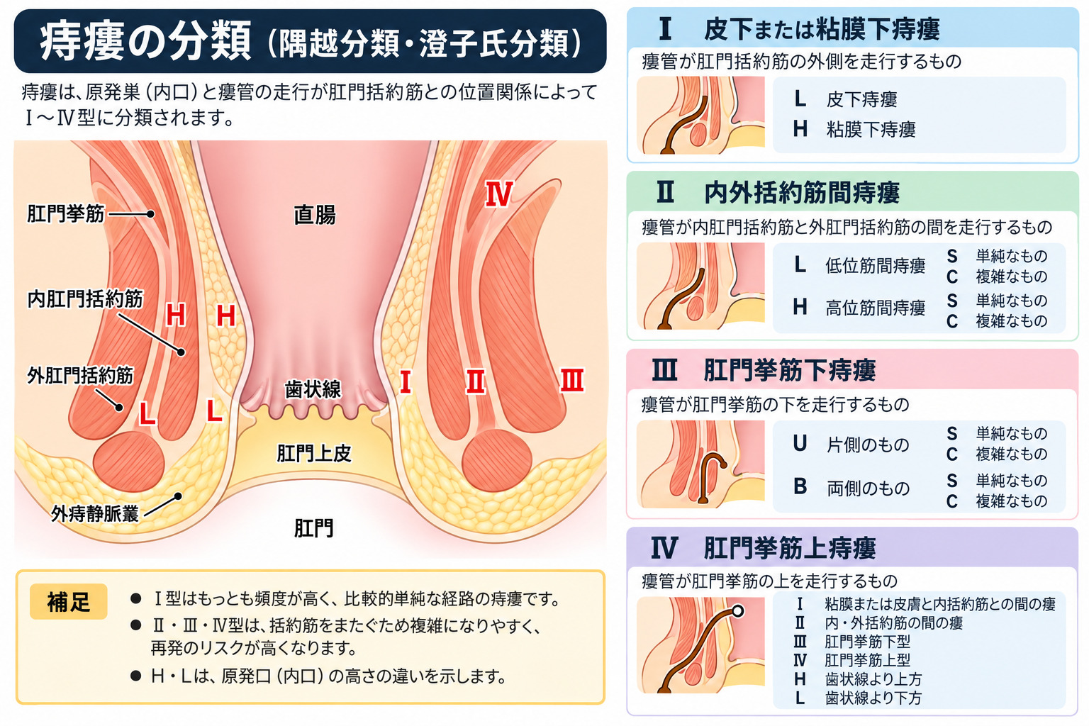 痔瘻の隅越分類。Ⅰ型からⅣ型までの瘻管の走り方を、内肛門括約筋・外肛門括約筋・肛門挙筋との位置関係で示した模式図