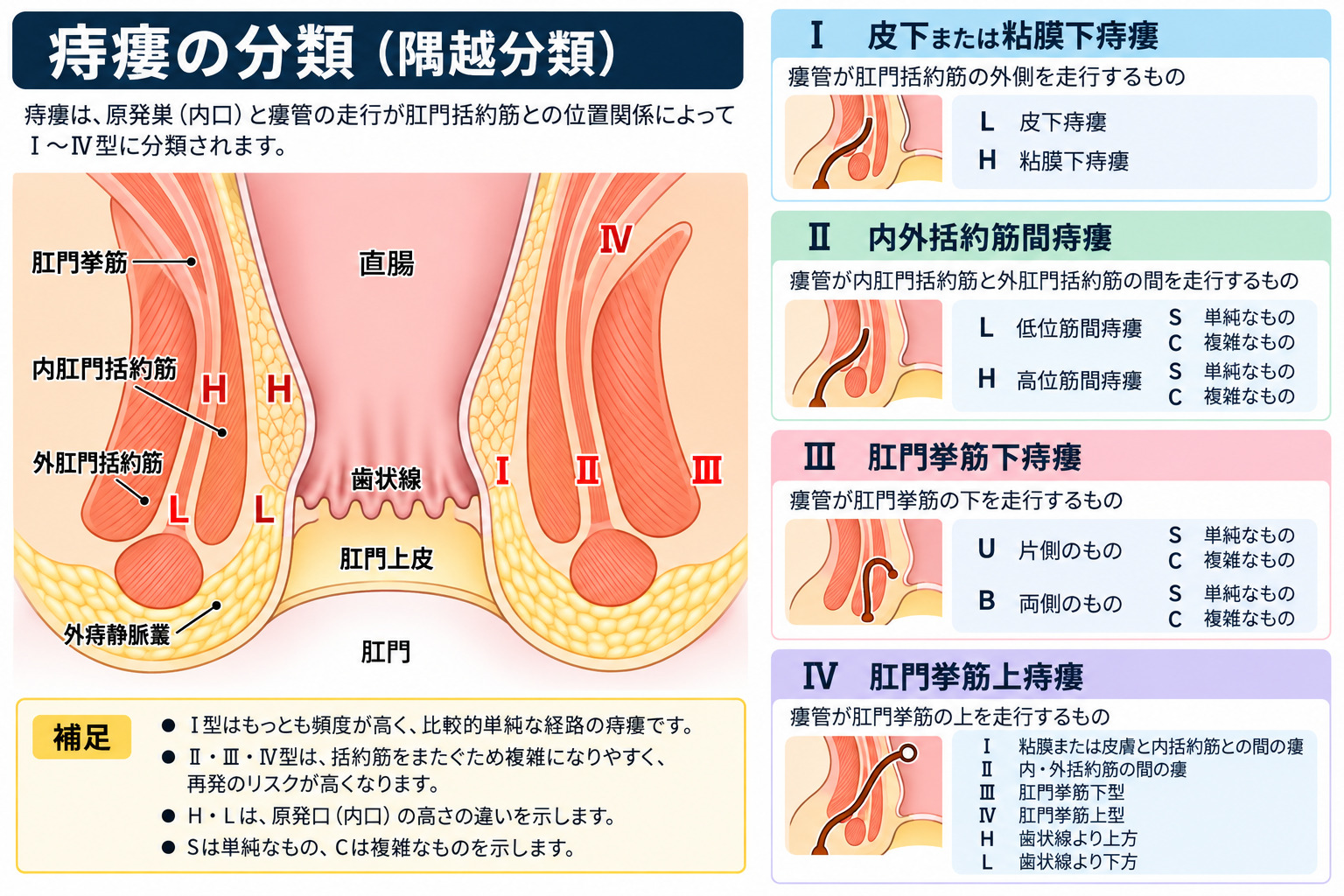 痔瘻（あな痔）の構造。原発口・原発巣・瘻管・二次口の位置を示した模式図