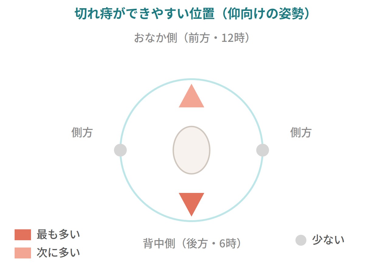 切れ痔(裂肛)ができやすい肛門の位置